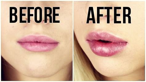 lip plumper gevaarlijk